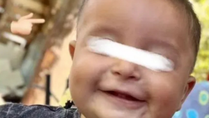 EMILIO PRÓTESIS CRANEAL