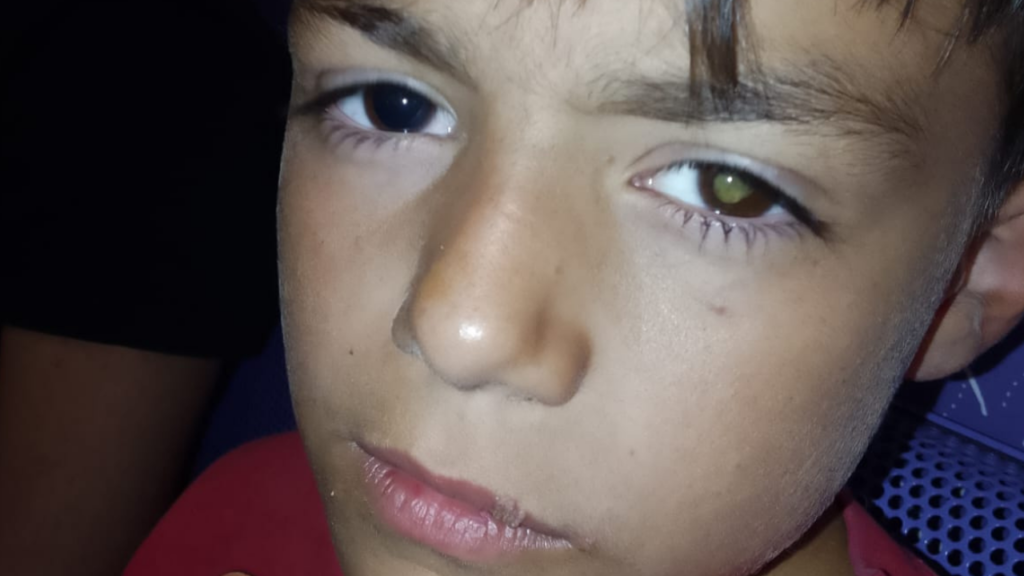 COLECTA PRÓTESIS OCULAR